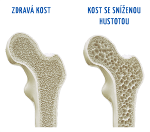 Rozdíl mezi zdravou kostí a kostí se sníženou hustotou